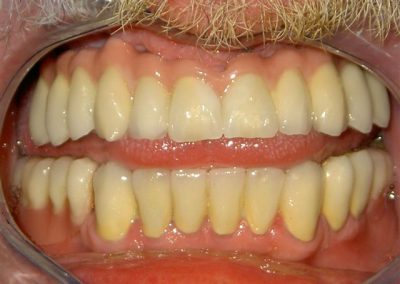 Implantatprothetische Versorgung bei total fehlenden Zähnen