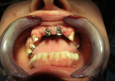 Implant prosthetic care for missing multiple teeth