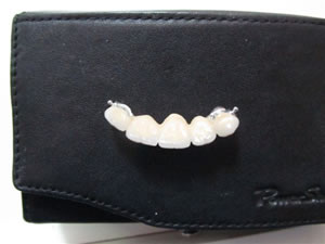 Prothetische Versorgung bei einseitig fehlenden Zähnen